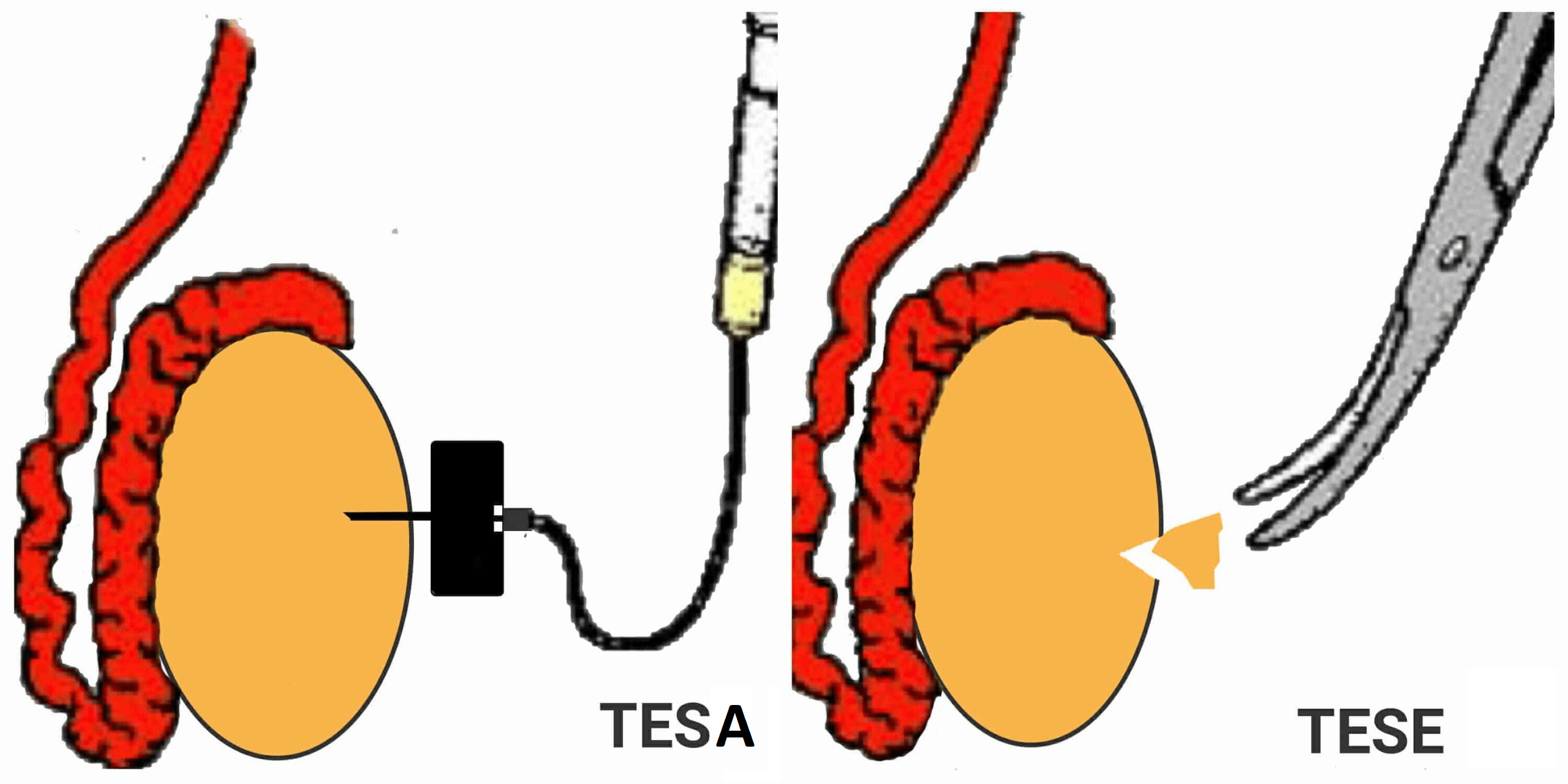 TESA vs TESE comparison diagram